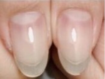 仙殊の写真/爪でお悩みの方≪深爪・巻き爪・削られすぎて痛んだ爪≫爪に負担をかけずにネイルを楽しみたい方に◎