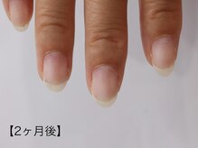 イズ(...is)/自爪育成　ケース5