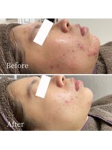 ニキビ研究所 町田店/思春期ニキビも大人ニキビもケア