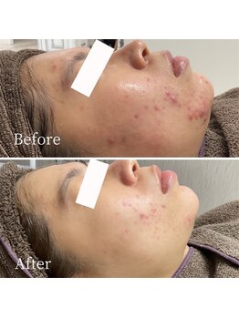 ニキビ研究所 町田店/思春期ニキビも大人ニキビもケア