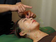 上野毛駅前整骨院 鍼灸院/美容鍼