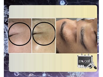 ウィズサロン 天神大名店(withサロン)/プロセル肌診断モニター付き