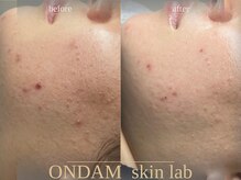 オンダム 表参道(ONDAM)/赤みニキビケアもお任せください