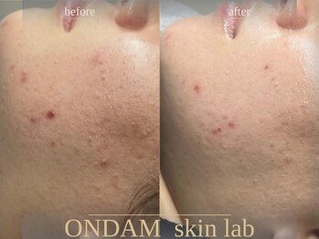 オンダム 表参道(ONDAM)/赤みニキビケアもお任せください