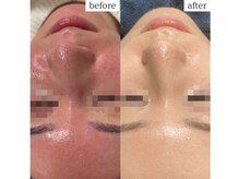 ルポ(RUPO)/慢性的な赤み（20代）