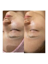 サロンドエデン 恵比寿店(Salon de Eden)/REVI剥けないハーブ