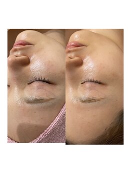 サロンドエデン 恵比寿店(Salon de Eden)/REVI剥けないハーブ