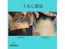 アクト クロ(ACT curro)/【うなじ襟足】脱毛施術例