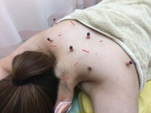 琴似女性の治療院/美身鍼灸