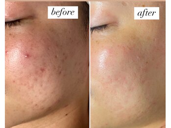 ビーアンドアイ シズオカテン レディース(B&I SHIZUOKA)/20代男性 ニキビケア2回目