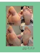 ふっとっと/角質ケア　before　after