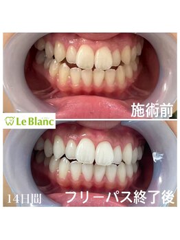 ルブラン 奈良店(Le Blanc)/14日間ご都合の良い日にケア!
