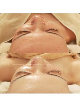 ミールーム(mi room)/フェイシャルマシン施術前後