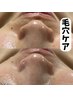 【毛穴の黒ずみ】ハーブピーリング　REVI （剥離なし）￥19,800→￥10,000
