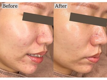 あすはれ/肌荒れに悩むあなたにララピール