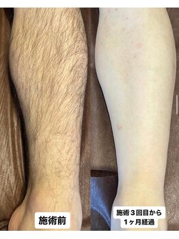 アレッド 大阪店(ared.)/足脱毛