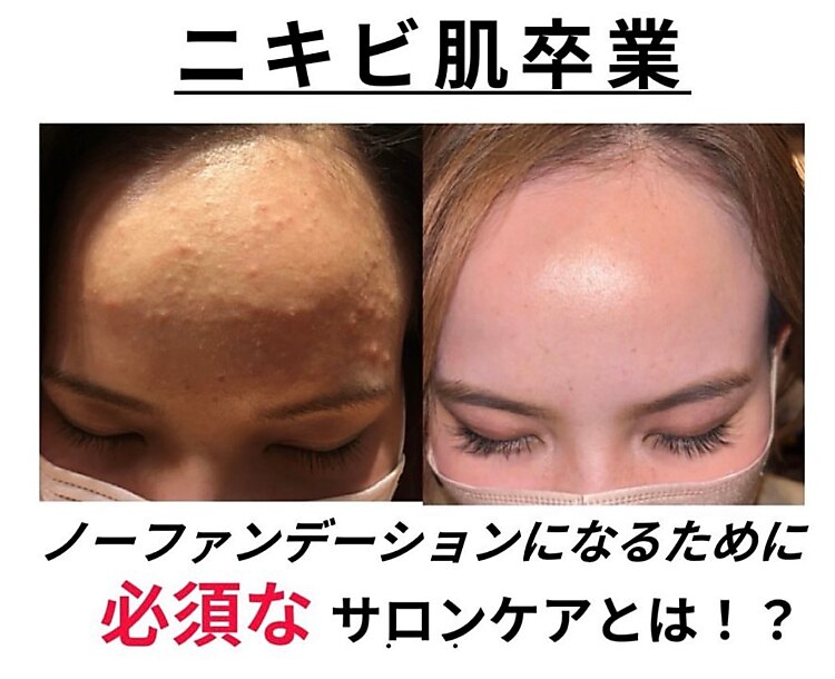 【肌の本気改善】※肌解析付き（フルコース2回） ￥39,600→16,500　