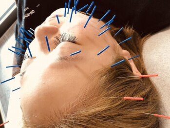 オカ鍼灸院(OKA鍼灸院)の写真/【美容鍼・小顔矯正×全身整体】OKA式美容鍼は、むくみやすい/顔のシワたるみが気になる方にオススメ★