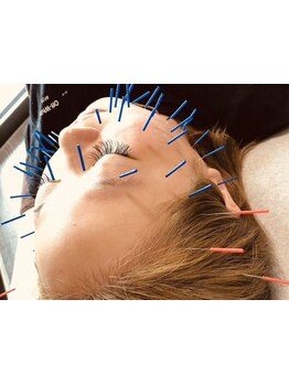 鍼灸施術を受けたい