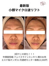 メゾンリュバン 梅田店(Maison Ruban)&nbsp;小顔 マイクロ波