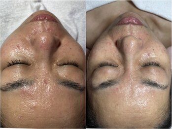 スパークル/小顔/脱毛/フェイシャル/毛穴