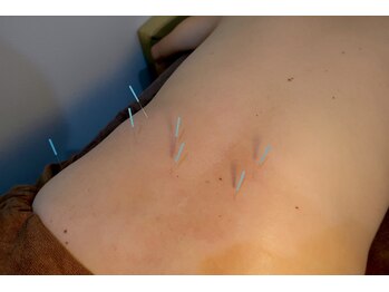 ことぶき整骨院/腰痛に鍼灸