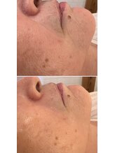 大場はりきゅう接骨院 整体院/【美容鍼】