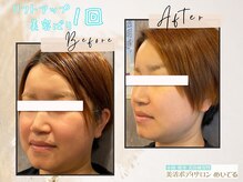 めいてる/【リフトアップ美容ばり】１回