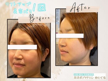 めいてる/【リフトアップ美容ばり】1回