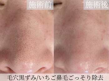 ハイフン(HIFUN)/毛穴黒ずみいちご徹底鼻毛穴ケア