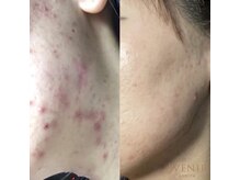 アベニール 芦屋/慢性ニキビ肌質改善