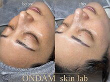 オンダム 表参道(ONDAM)/透明感爆発の白玉ツヤ肌♪