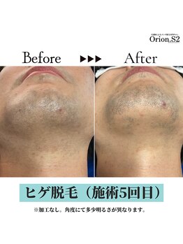 オリオンドットエスツー(Orion.S2)/【Before→After】