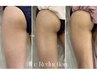【痩身】脂肪冷却+セルゼロで速脂肪離脱!速攻確実な結果にはこれ!2cup