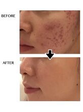 エンルーチェ(en;Luce)/サーマナイフ　× &nbsp;エレポレ