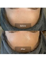 エヌ(enu)/毛穴洗浄/フェイシャル