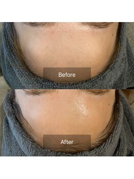 エヌ(enu)/毛穴洗浄/フェイシャル