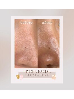 パール エビス(Pearl Ebisu)/ハイドラフェイシャル