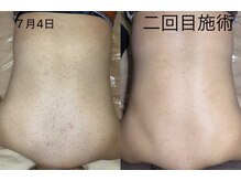 ウィズサロン 天神大名店(withサロン)/背中毛孔性ハーブピーリング