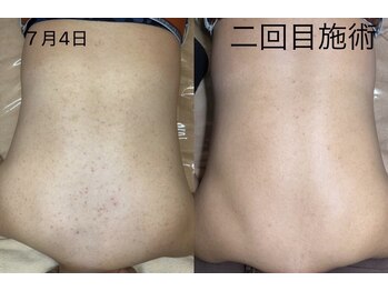 ウィズサロン 天神大名店(withサロン)/背中毛孔性ハーブピーリング