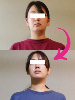 チャラク(charaku)/【20代K様：ブライダル+痩身】