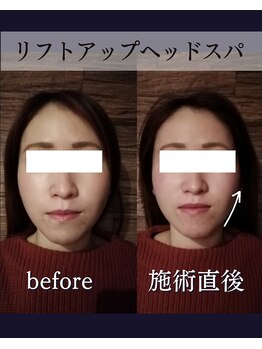 ヘッドラボ(Headlabo★3103)/リフトアップヘッドスパ