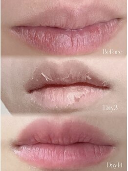 メディカルエース(MedicalAce)/ROMA PINK