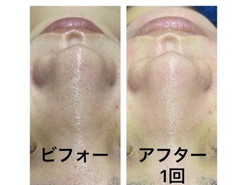 サルヴァトーレ 長崎/シミシワ改善/ニキビケア/毛穴