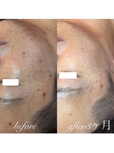 プライベートサロン コットン(COTTON)/肌改善プログラム