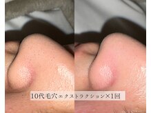 ル シーニュ/毛穴エクストラクション