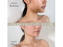 術後の女神 大阪本町店/ダウンタイムケア・インディバ