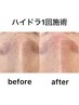 【水素クリアフェイシャル】水素洗浄+ピーリング☆毛穴・角質ケア！
