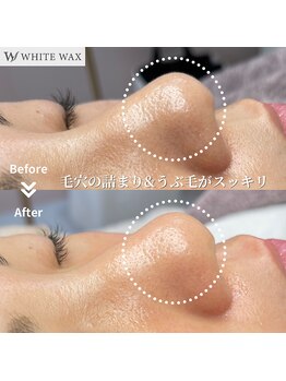 ホワイトワックス 浜松(WHITE WAX)/毛穴悩みにフェイシャルワックス