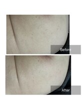 ダンニヒル(dannihil)/【おしりケア】50代会社員2回目